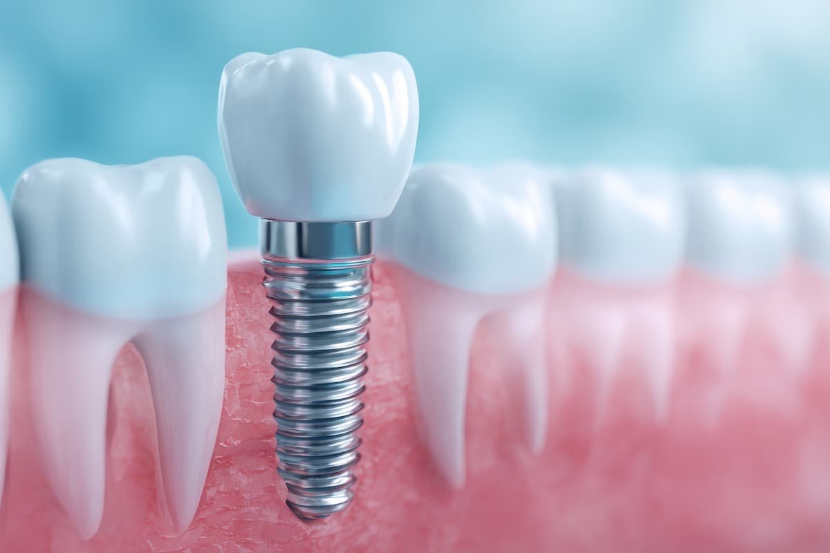 How to Compare Dental Implant Plans for Better Long-Term Results